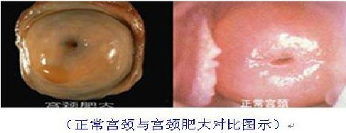 “第2代SPA微创射频消融术”——有效祛除宫颈肥大